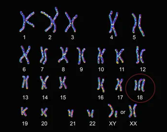 Trisomia 13 e 18: non sono incompatibili con la vita 1